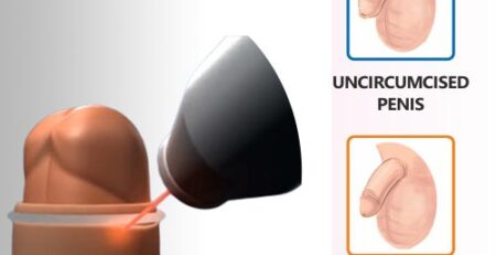 Laser Circumcision
